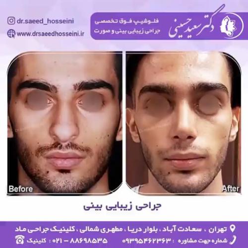 جراحی-بینی-351