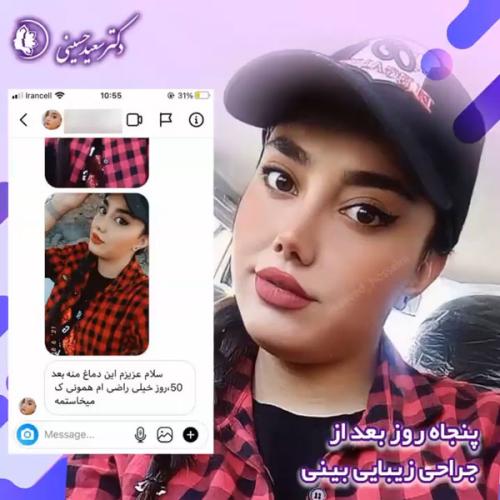 جراحی-بینی-352