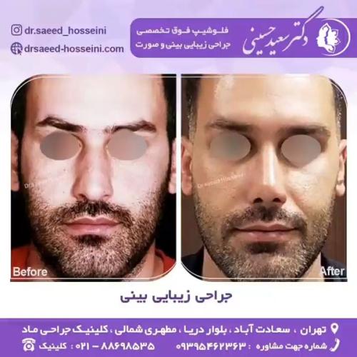 جراحی-بینی-353