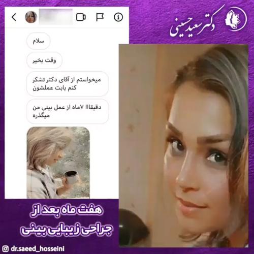 جراحی-بینی-354