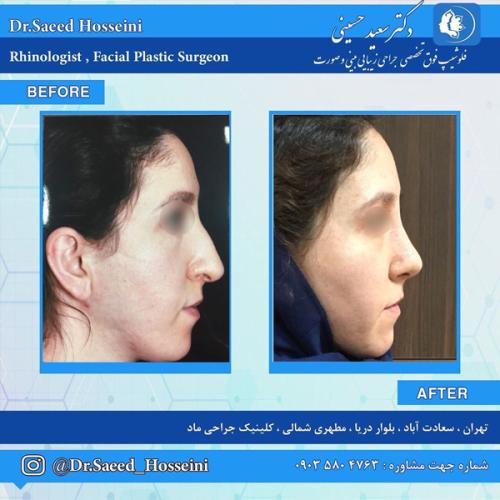 جراحی-بینی290