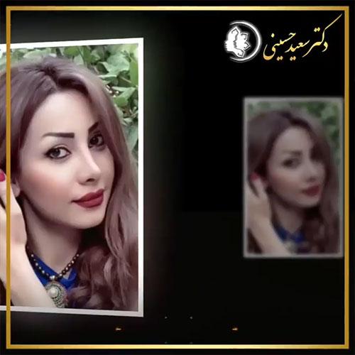 جراحی-بینی-152