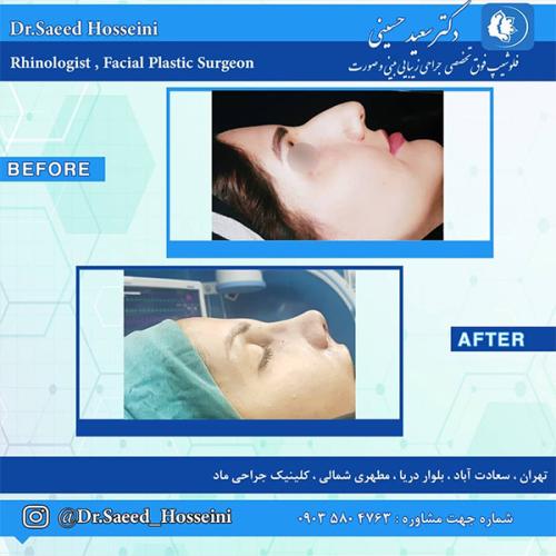 جراحی-بینی-206