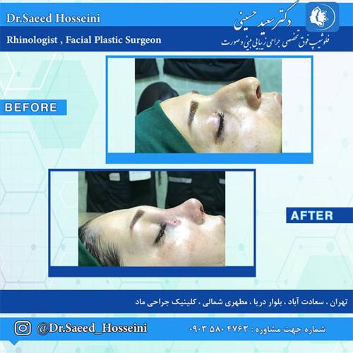 جراحی-بینی-208