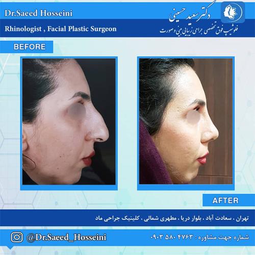 جراحی-بینی-209