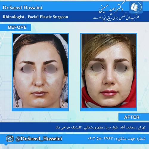جراحی-بینی-211