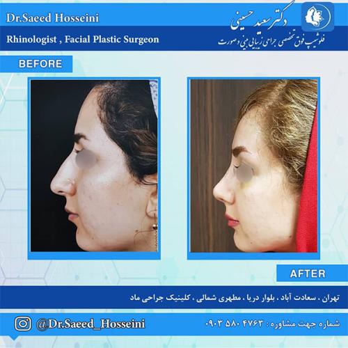 جراحی-بینی-212