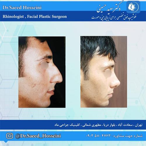 جراحی-بینی-213