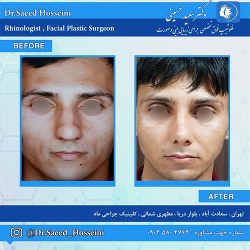 جراحی-بینی-214