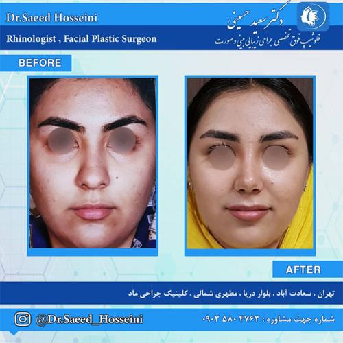 جراحی-بینی-215