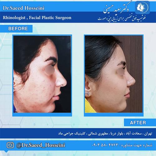 جراحی-بینی-216