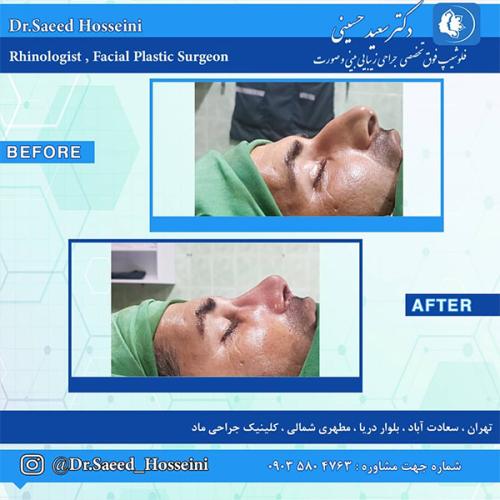 جراحی-بینی-217