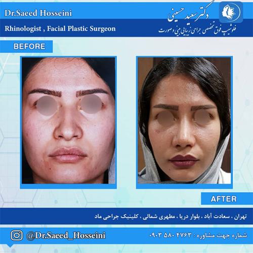 جراحی-بینی-220