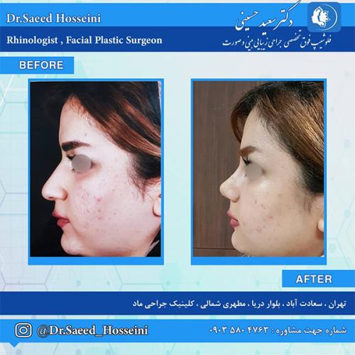 جراحی-بینی-221