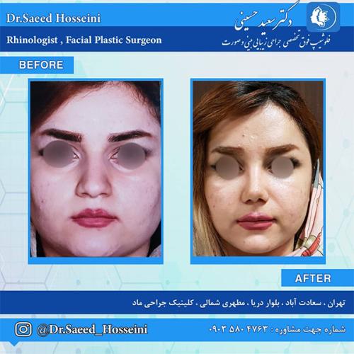 جراحی-بینی-222
