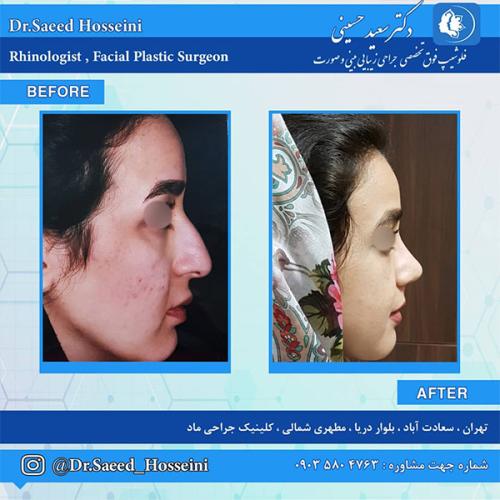 جراحی-بینی-223