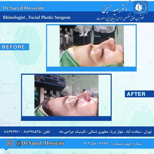 جراحی-بینی-225