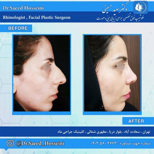جراحی-بینی-226