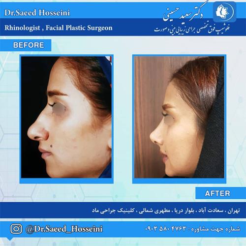 جراحی-بینی-227