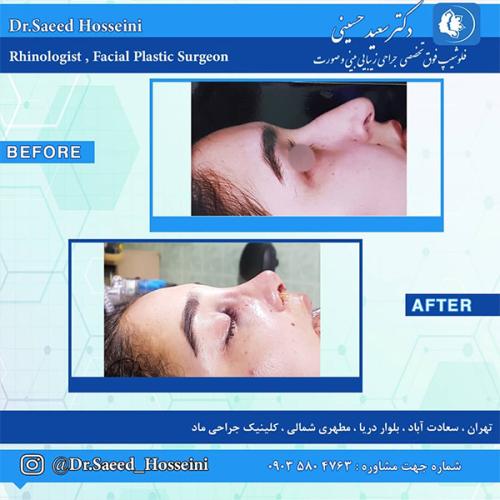 جراحی-بینی-228