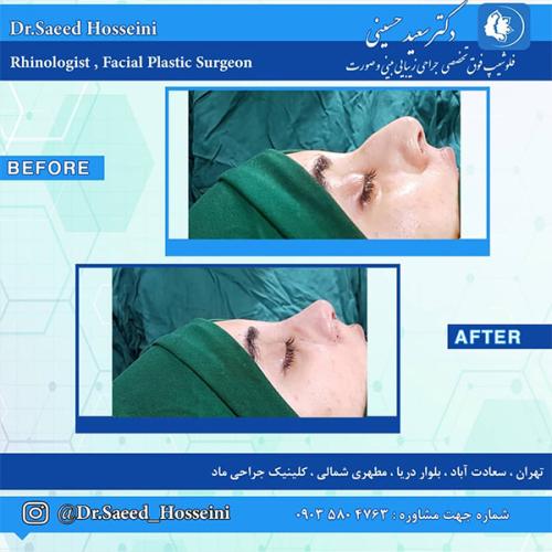 جراحی-بینی-230
