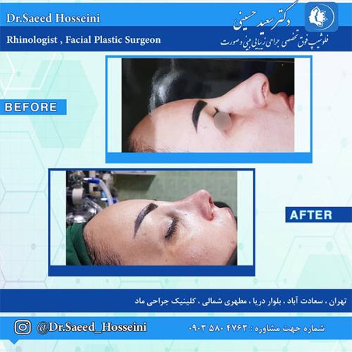 جراحی-بینی-231