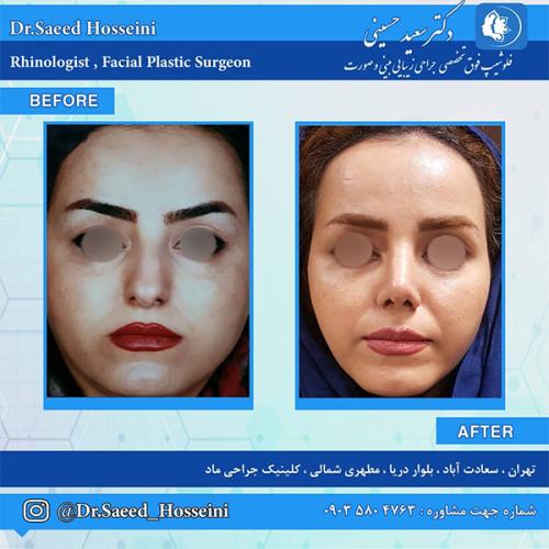 جراحی-بینی-232