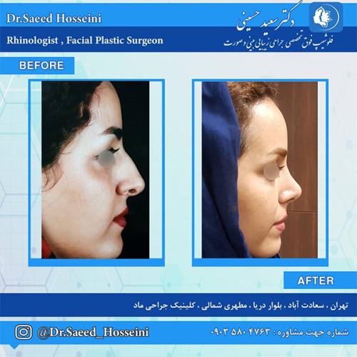 جراحی-بینی-233