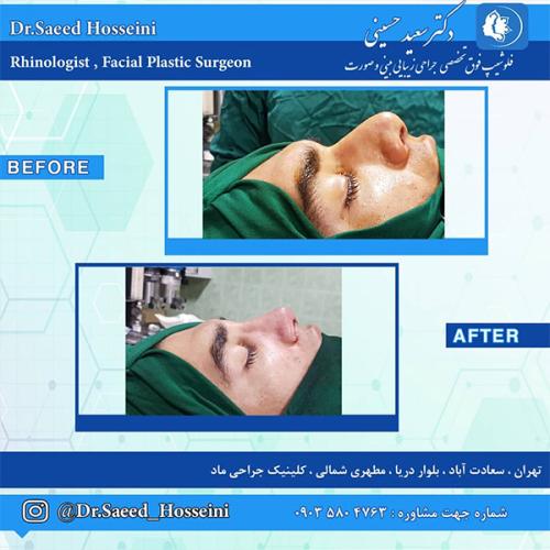 جراحی-بینی-234