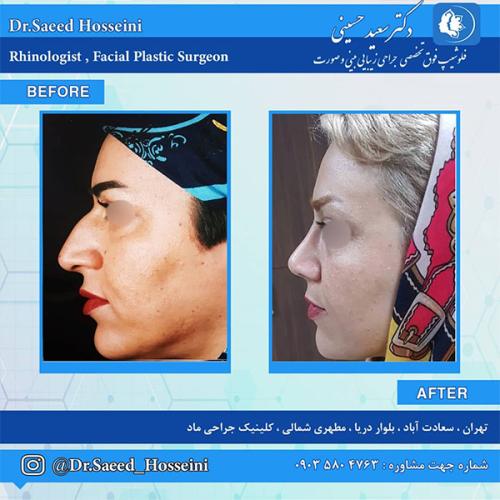جراحی-بینی-235