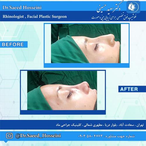 جراحی-بینی-238