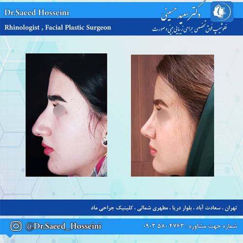 جراحی-بینی-239