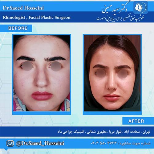 جراحی-بینی-240