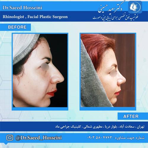 جراحی-بینی-241