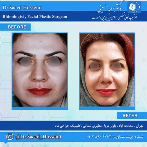 جراحی-بینی-242