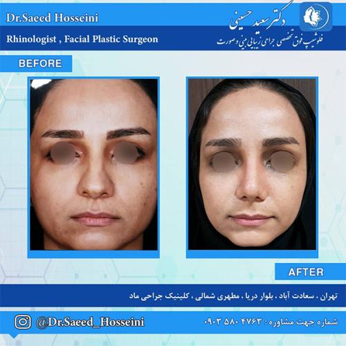 جراحی-بینی-243