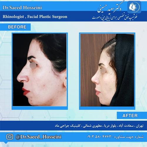جراحی-بینی-244