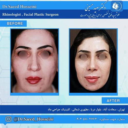 جراحی-بینی-245