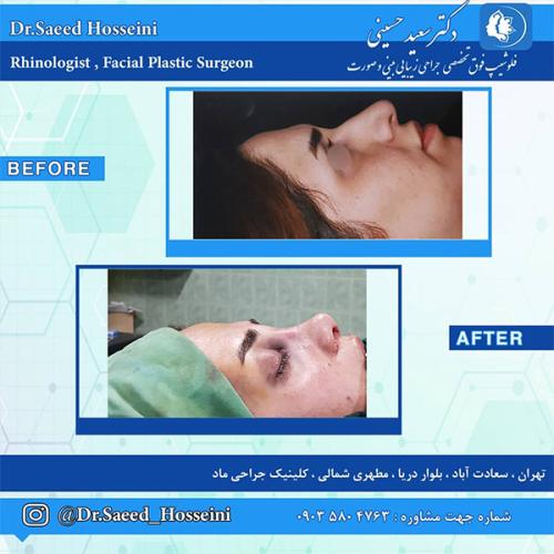 جراحی-بینی-249