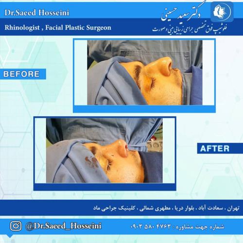 جراحی-بینی-274