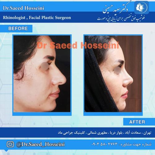 جراحی-بینی-275
