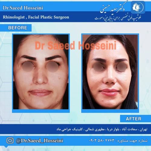 جراحی-بینی-276