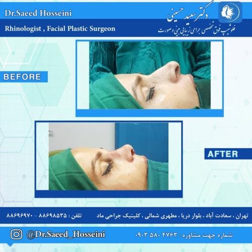 جراحی-بینی-278