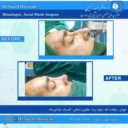 جراحی-بینی-279