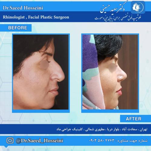 جراحی-بینی-280