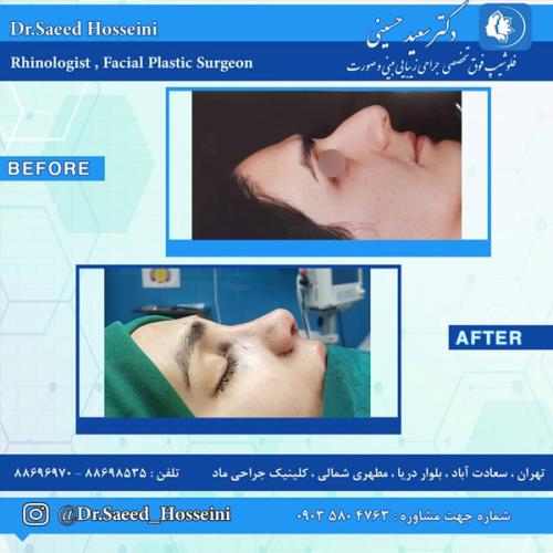 جراحی-بینی-281