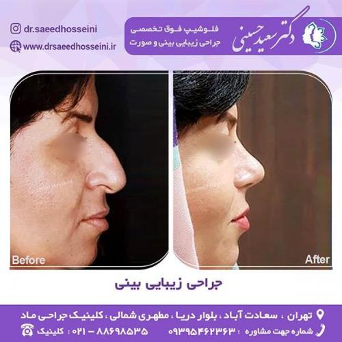 جراحی-زیبایی-بینی-1