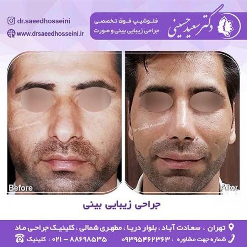 جراحی-زیبایی-بینی-100