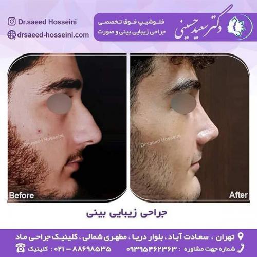 جراحی-زیبایی-بینی-11