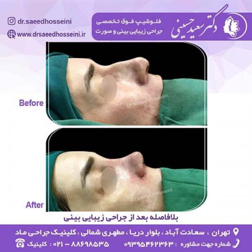 جراحی-زیبایی-بینی-128